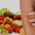 psoriasi alimenti che aiutano a migliorare