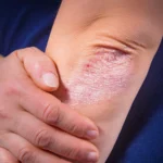 Chiazze ruvide sui gomiti: le cause comuni che tendiamo sempre a ignorare