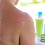 Il piano in 3 mosse per curare le scottature ed evitare di spellarsi