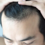 La biologia della caduta dei capelli: cosa succede davvero al follicolo