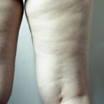 Linfedema-nelle-gambe