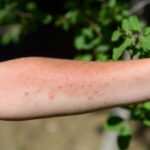 Puntini rossi sulle braccia dopo aver preso il sole: come distinguerli da un'allergia