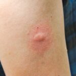 Puntura di zanzara infetta