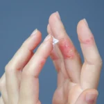 Ragadi-sulle-dita-delle-mani