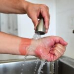 Tecnica per ridurre le ustioni da bruciatura