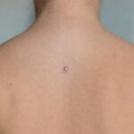 come trattare una cisti sebacea dietro la schiena