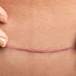 Perché alcune cicatrici cambiano con il tempo?