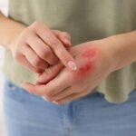 Tagli, Ustioni e Contusioni: Gli Errori Più Frequenti