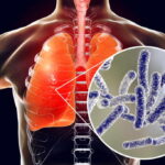 legionella in estate