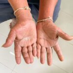 segnali sclerodermia