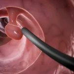 Colonscopia: guida completa all'esame del colon per la prevenzione del cancro colorettale