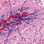 Infezioni da muffe invasive: rischi, diagnosi e prevenzione nelle terapie intensive