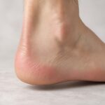 perché capita di sentire il tallone pungere