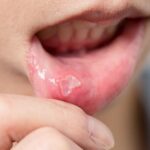 perché in estate le afte compaiono più spesso