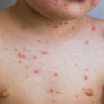 questi primi sintomi sono il chiaro segnale della varicella