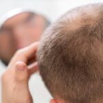 Alopecia areata: quando i capelli cadono in zone circoscritte