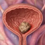 Calcoli alla vescica: quali sintomi possono provocare