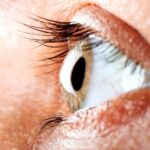 Cheratocono quali sono i primi campanelli d'allarme