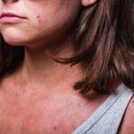 Dermatite atopica dopo i 40 anni perché può comparire anche quando non l'hai mai avuta