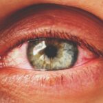 Distacco della retina: quali cambiamenti improvvisi nella vista richiedono attenzione