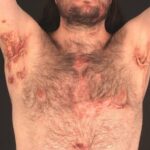 Idrosadenite suppurativa: quando noduli e infiammazioni compaiono in alcune zone della pelle
