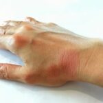 Lupus: primi sintomi e segnali da riconoscere