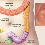 Polipi intestinali: cosa sono e perché vengono individuati durante la colonscopia