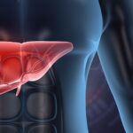 Steatosi Epatica: Sintomi, Cause e Gli Alimenti da Mangiare