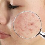 Acne adulta: cause, sintomi e cosa può aiutare