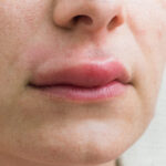 Angioedema ereditario: cosa provoca i gonfiori improvvisi dei tessuti