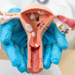 Fibromi uterini: perché possono provocare mestruazioni molto abbondanti