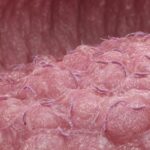 Helicobacter pylori: sintomi, contagio e come si diagnostica