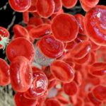 Mielofibrosi: quando il tessuto del midollo osseo viene progressivamente sostituito da tessuto fibroso