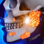 Parotite: cosa succede quando il virus colpisce le ghiandole salivari