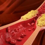 Qual è la salsa che tutti amano ma causa brutti problemi alle arterie