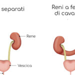 Rene a ferro di cavallo: quali conseguenze può avere questa particolare anatomia
