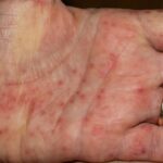 Scarlattina negli adulti: quali sintomi possono comparire oltre all'eruzione cutanea