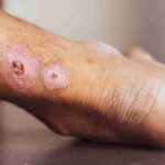 come trattare una piaga da decubito